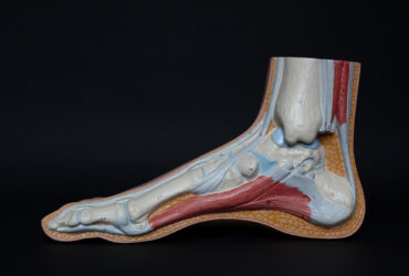 neuroma di morton